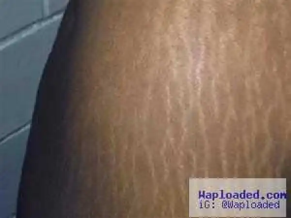 4 Ways To Get Rid Of Stretch Marks